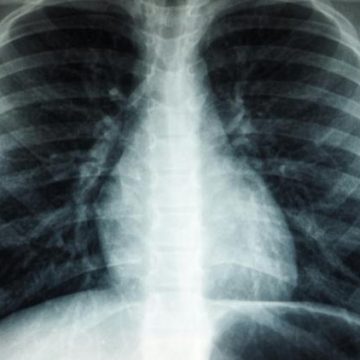 Un programme automatisé de dépistage du cancer du poumon lancé en France