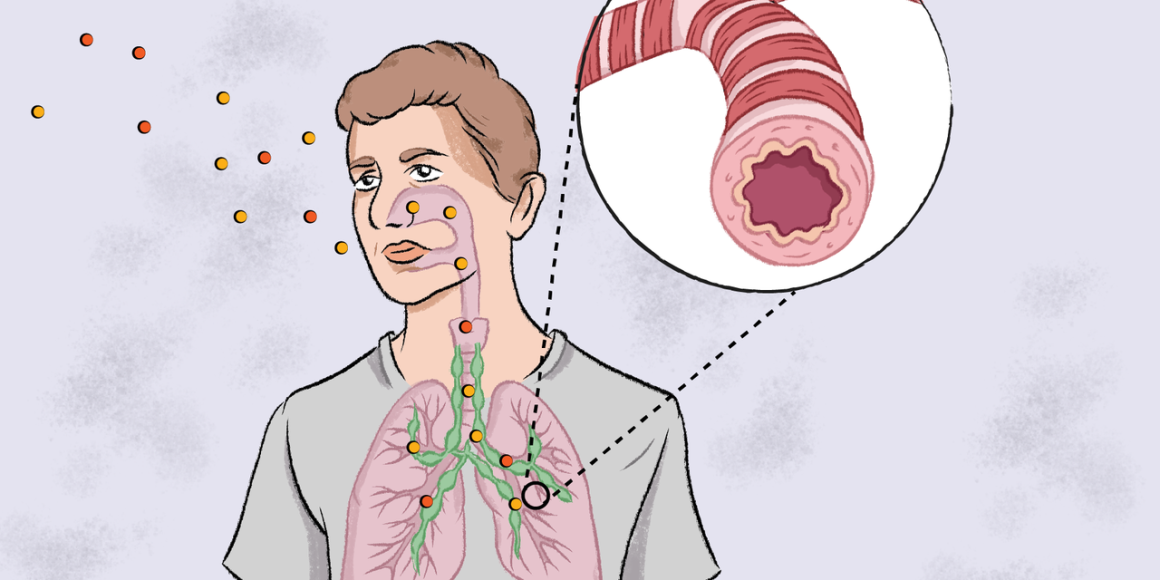 L’impact de l’asthme et les avancées médicales
