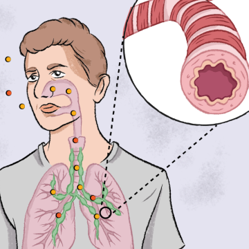 L’impact de l’asthme et les avancées médicales