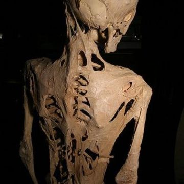 Fibrodysplasie ossifiante progressive : une maladie génétique rare et dévastatrice