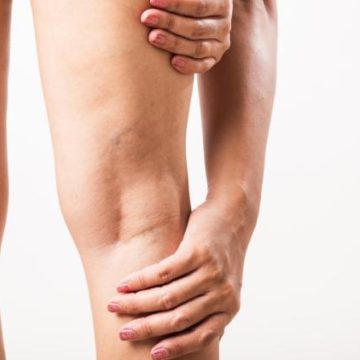 Varices : Symptômes et Facteurs de Risque