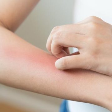 47c7f2d0-850b-4037-ab20-b32835a3a4c0 Épidémie de Leishmaniose à Toulouse : Informations Clés