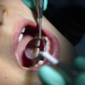 Le recul du remboursement des soins dentaires par l&rsquo;Assurance maladie : conséquences et controverses