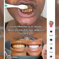 Attention aux vidéos pour blanchir les dents