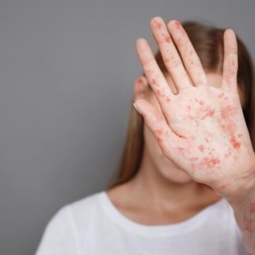 Recrudescence de la rougeole aux États-Unis : un enjeu de santé publique